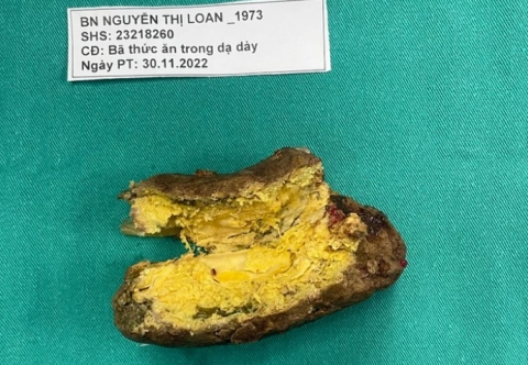 Thủng dạ dày, suy đa tạng vì… tinh bột nghệ